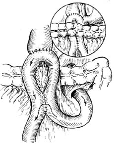 胆囊空肠肠袢型吻合术图片