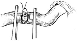 间置空肠胆管十二指肠吻合术图片