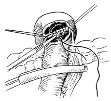 胆囊空肠Y形吻合术图片