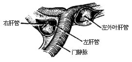 肝胆管盆式胆肠内引流术图片