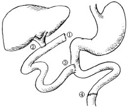 间置空肠胆管十二指肠吻合术图片