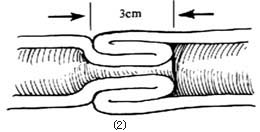 肝胆管盆式胆肠内引流术图片