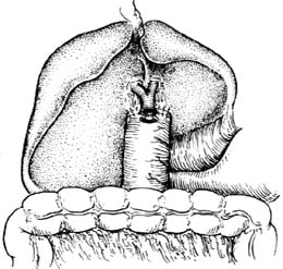 肝外胆管损伤及狭窄修复术图片