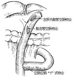 左肝内胆管、胆总管空肠侧侧吻合术图片