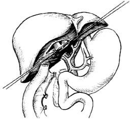 先天性胆总管囊肿手术图片