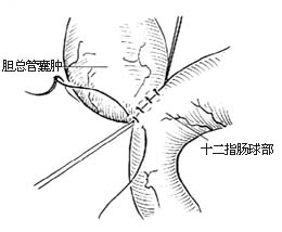 先天性胆总管囊肿手术图片