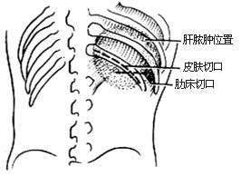 经后侧腹膜外肝脓肿切开引流术图片