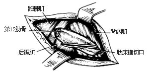 经后侧腹膜外肝脓肿切开引流术图片
