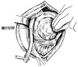 左半肝切除术图片