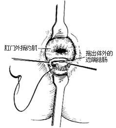 结肠直肠切除直肠后吻合术图片