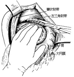 左半肝切除术图片