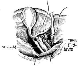 左半肝切除术图片