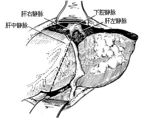 左半肝切除术图片