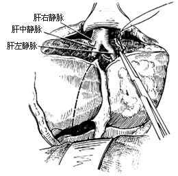 左半肝切除术图片
