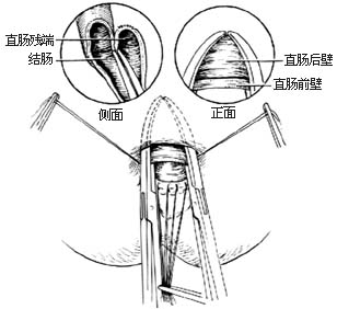 结肠直肠切除直肠后吻合术图片