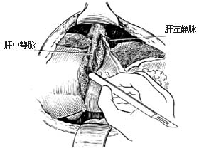 左半肝切除术图片