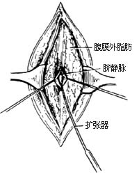 经脐静脉门静脉插管术图片