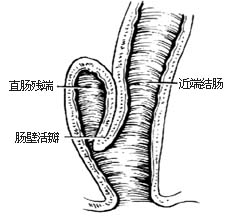 结肠直肠切除直肠后吻合术图片