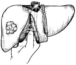 右半肝切除术图片