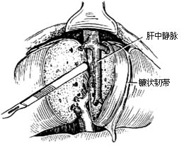 右半肝切除术图片