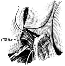 右半肝切除术图片