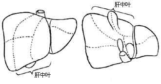 肝中叶切除术图片