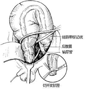 经直肠肌鞘结肠拖出术图片