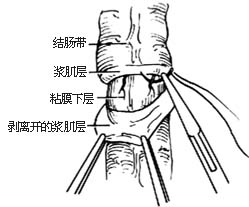 经直肠肌鞘结肠拖出术图片