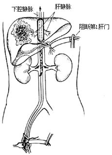 无血肝切除术图片