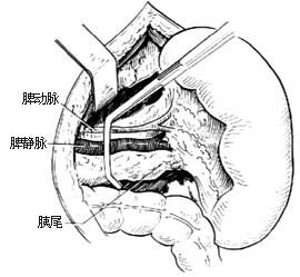 脾肾静脉分流术图片