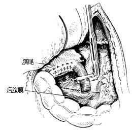 脾肾静脉分流术图片