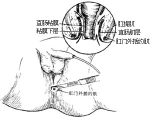 经直肠肌鞘结肠拖出术图片