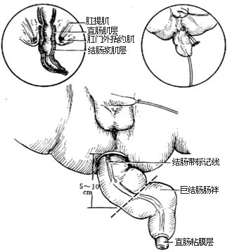 经直肠肌鞘结肠拖出术图片
