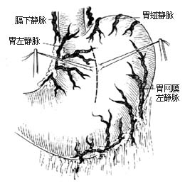 胃底静脉缝扎术图片