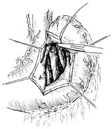 胃底静脉缝扎术图片
