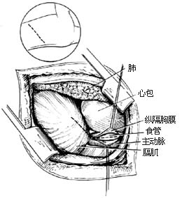 经胸食管下段和胃底曲张静脉缝扎术图片