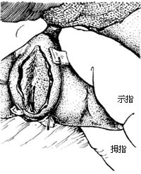 脾缝合修补术图片