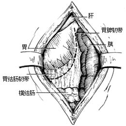 脾切除术图片