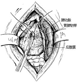 脾切除术图片
