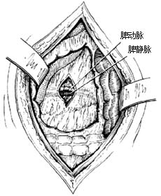 脾切除术图片