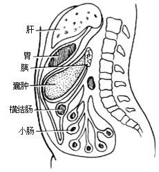 胰假性囊肿切除和内引流术图片