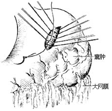 胰假性囊肿切除和内引流术图片