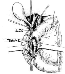 胰假性囊肿切除和内引流术图片