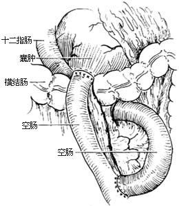 胰假性囊肿切除和内引流术图片