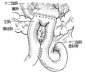 胰假性囊肿切除和内引流术图片