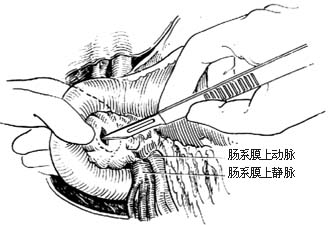 胰头、十二指肠切除术图片