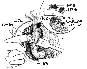 胰头、十二指肠切除术图片