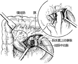 胰头、十二指肠切除术图片