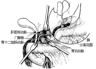 胰头、十二指肠切除术图片