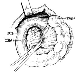 胰头、十二指肠切除术图片